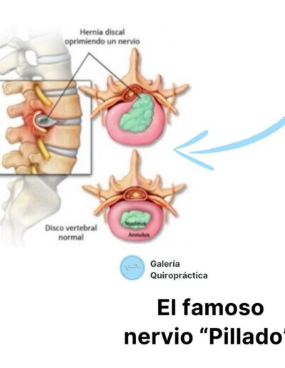 nervio pillado